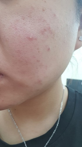 Các mom có bầu có bị nổi mụn trên mặt không ạ? Em có bầu 7w mà mặt nổi quá trời luôn :((