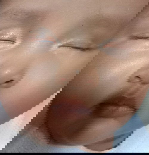 Bentol" putih di mata