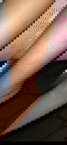 Ini kaki anak saya kering dan bekas lukanya krn sering dj garut sm anakku,apa ini termasuk alergi ?