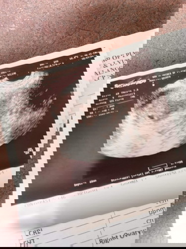 Hi po nag pa transv ultrasound po ako nng 15 pinapabalik po ako sa 1 para ulit. Normal pu ba yun?
