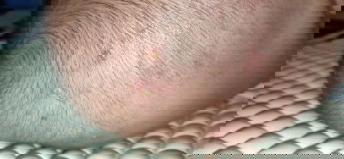 jerawat nanah di kepala