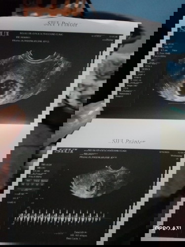 Hello po. normal po ba na more than once inuultrasound? 8weeks palang po ang baby ko.