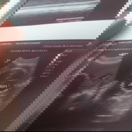 Breech Position