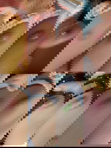 Penyembuhan Luka Nanah Bisul BCG