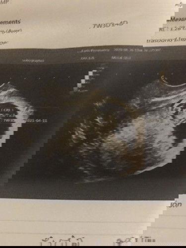 ไม่พบการเต้นของหัวใจ