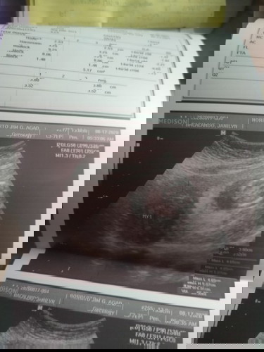 Preggy with Intramural Fibroid