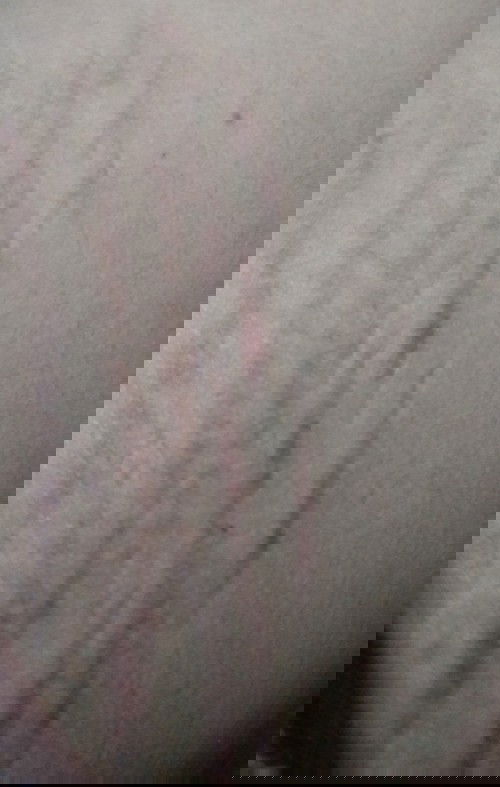 Stretch Mark