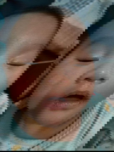 มีลูกคุณแม่ท่านไหนเคยเป็นไหมค่ะแบบที่แก้มน้องอ่ะค่ะ