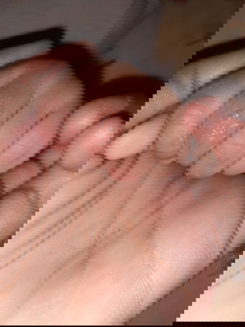 Alergi atau cacar air