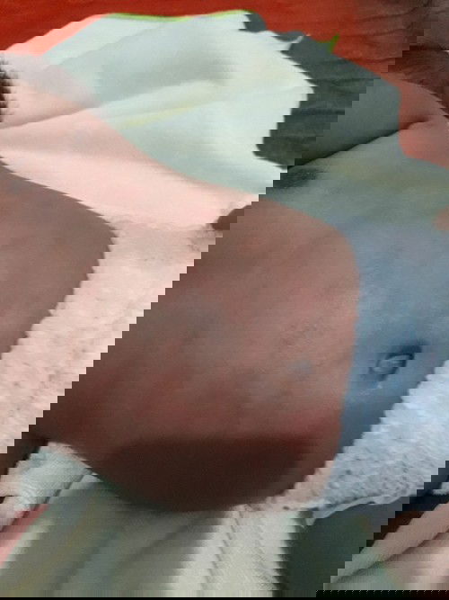 Merah- merah pada kulit bayi