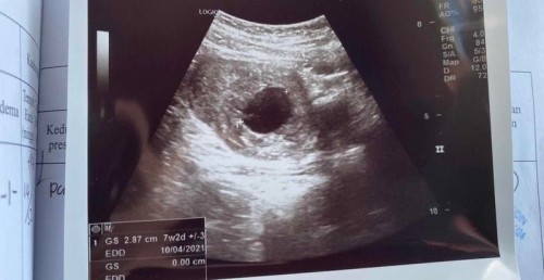 Mempercepatkan keguguran natural (kandungan kantung)