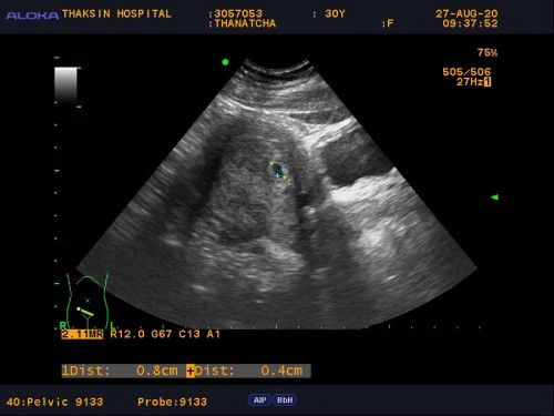 เลือดออกตอนท้อง 4week