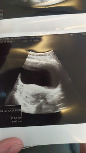 Bun.. kalo hamil sekitar 5 to 6 weeks kalo usg memang cuma setitik gitu ya?