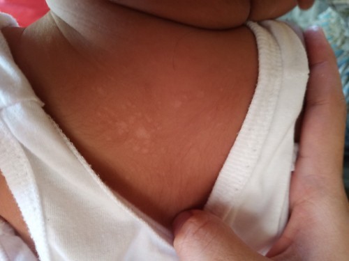 White spots on my baby's skin (An-an)???