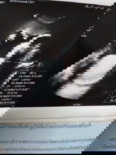 29 สัปดาห์ ลูกดิ้นน้อยลงค่ะ