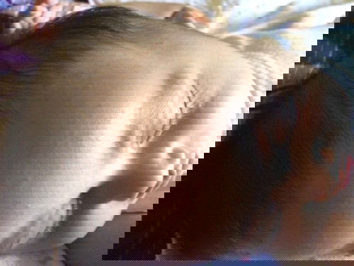 Bruntusan gatal di kepala