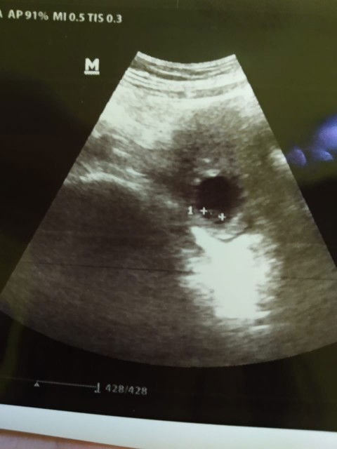 kantung hamil mengecil