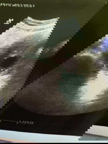 kantung hamil mengecil