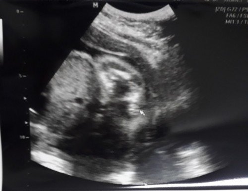 Girl or Boy?
