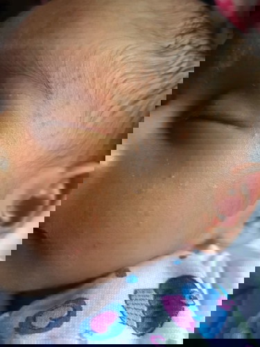 Newborn acne or rashes