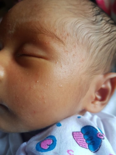 Newborn acne or rashes