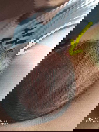 Sino po may same experience? bump on newborns head