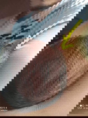 Sino po may same experience? bump on newborns head