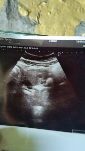 ini hasil usg 6 minggu 5 hari bun