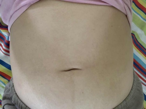 แม่ๆคนไหนท้องแตกลายบ้างไหมคะ