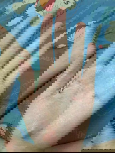 สอบถามแม่ที่เคยติดเชื้อซิฟิลิสหน่อยค่ะ