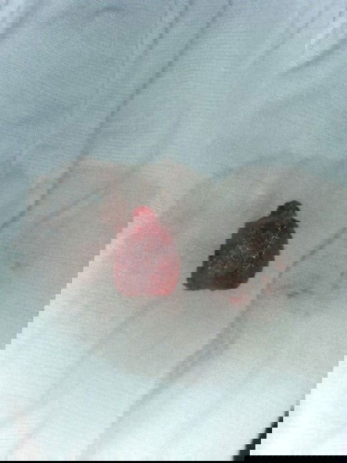 keguguran usia kehamilan 6 Minggu terus