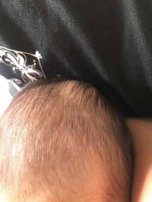 bayi 1 bulan ada benjolan dikepala
