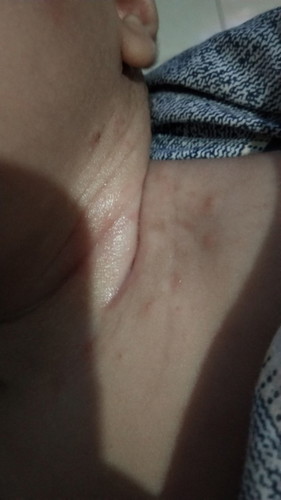 ruam antibiotik+salep