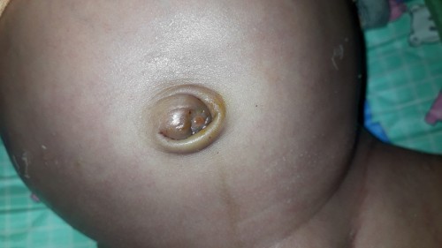 umbilical cord