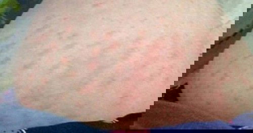 PUPPP (Pruritic Urticarial Papules and Plaques of Pregnancy)