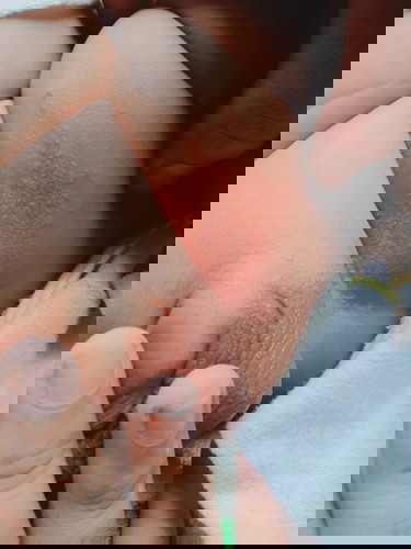 ผดผื่นข้างขา