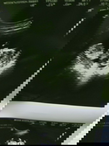 อัตราซาวด์13วีดรู้เพศแล้วค่ะ