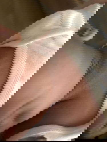 Skin discolouration on neck