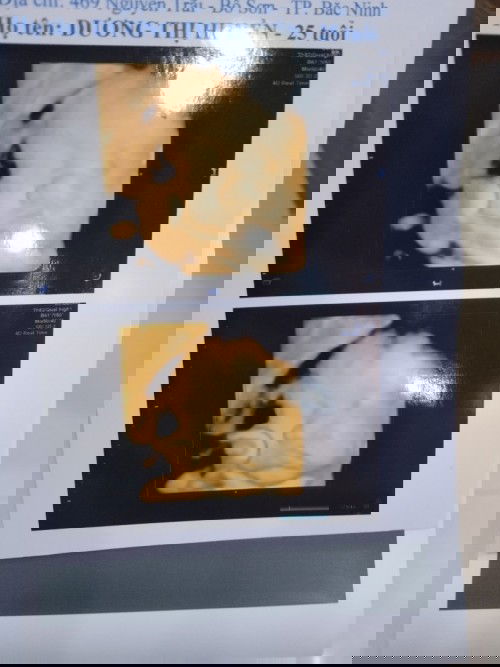 Gò và đau bụng dưới