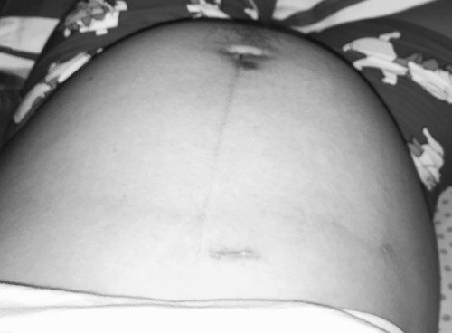 Laparoscopic Surgery