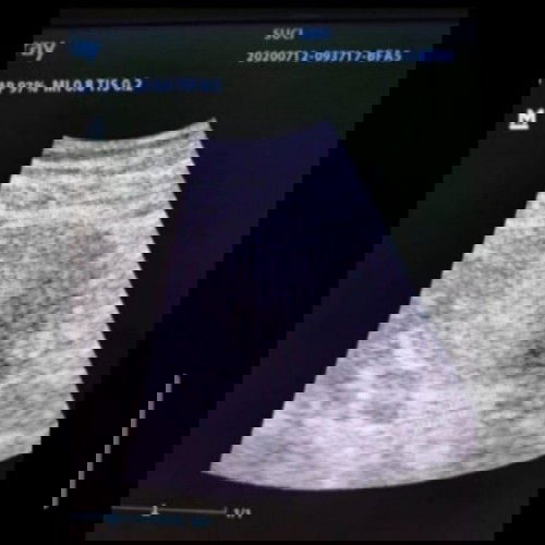 Tadinya Kantung Kehamilan dan Janin tidak terlihat, tapi setelah 2 bulan...
