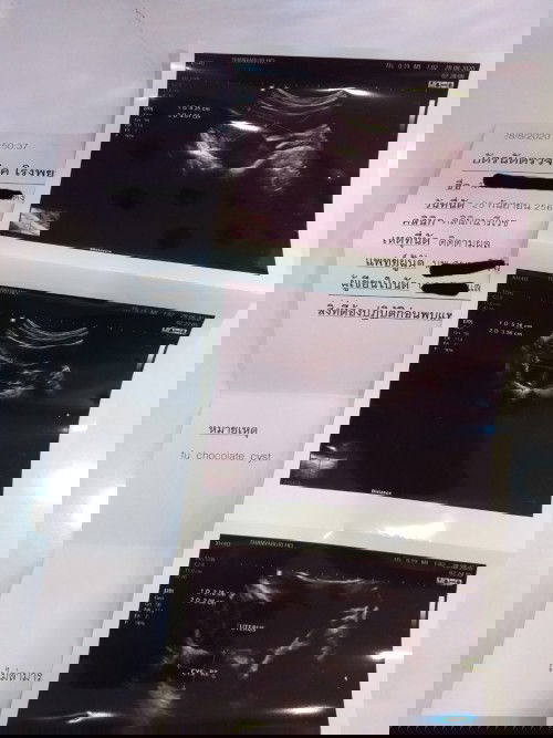 เป็นช็อกโกแลตซีสต์สามารถมีลูกได้ไหมค่ะ