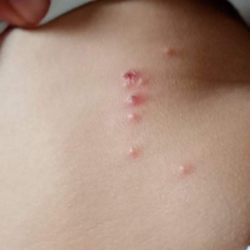 Insect bites or what