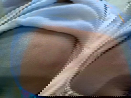 Kulit bayi bersisik mengelupas