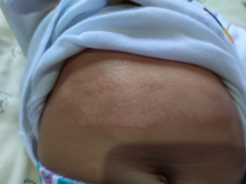 Kulit bayi bersisik mengelupas