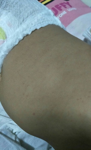 ไข้เลือดออก