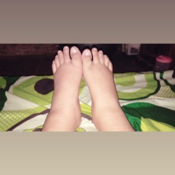 kaki bengkak