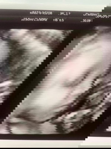 เข้า 28 สัปดาห์แล้วนะ ลูกคนที่สอง ผช จ้า 1,200 กรัม