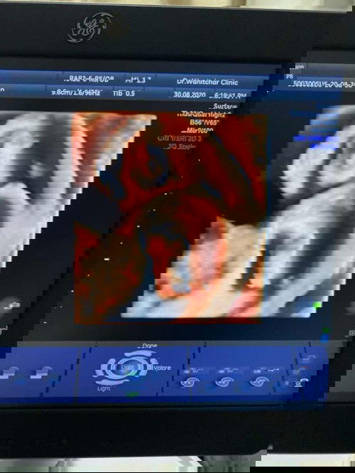 เคยแท้ง(ท้องลม)