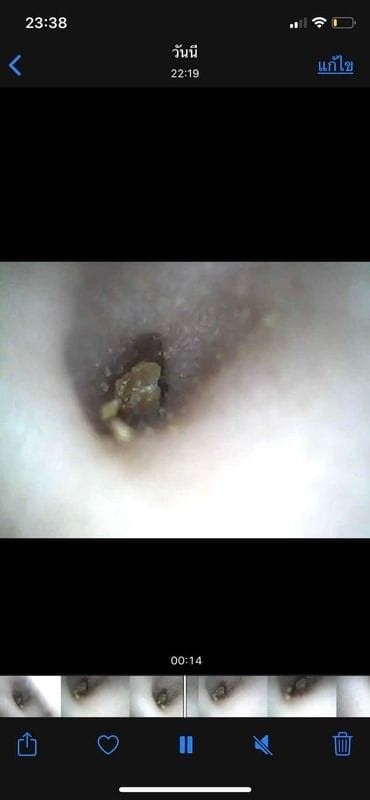 จะทำยังไงดี กะก้อนๆในหูลูกชาย 7 เดือน ดีคะ ผิดปรกติไหมคะ ใช้ไม้แคะหูติดกล้องคะ เลยเห็นชัดเจน